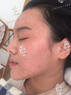 調理激素皮炎，中醫康復實錄 | 龍翔天潤患者案例分享